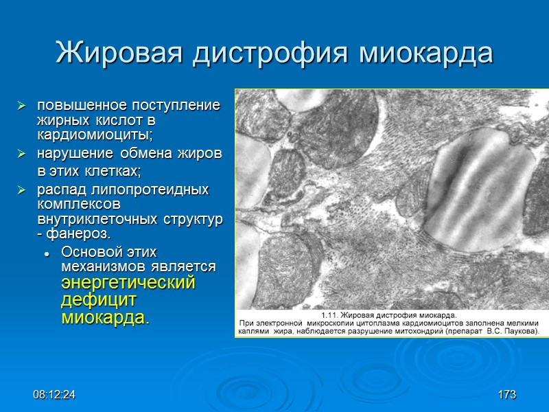 08:12:02 Жировая дистрофия миокарда повышенное поступление жирныx кислот в кардиомиоциты;  нарушение обмена жиров